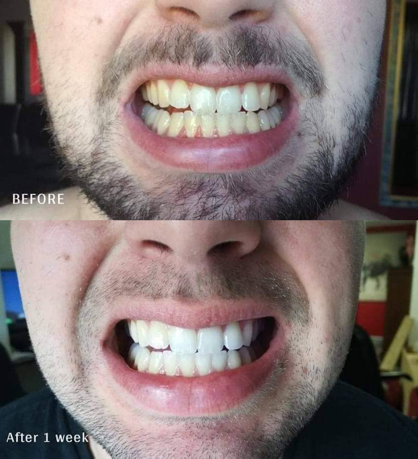 Erase past bad teeth hygiene habits by reading Snow teeth whitening Kit review