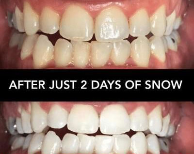 A desire to change with Snow teeth whitening fast