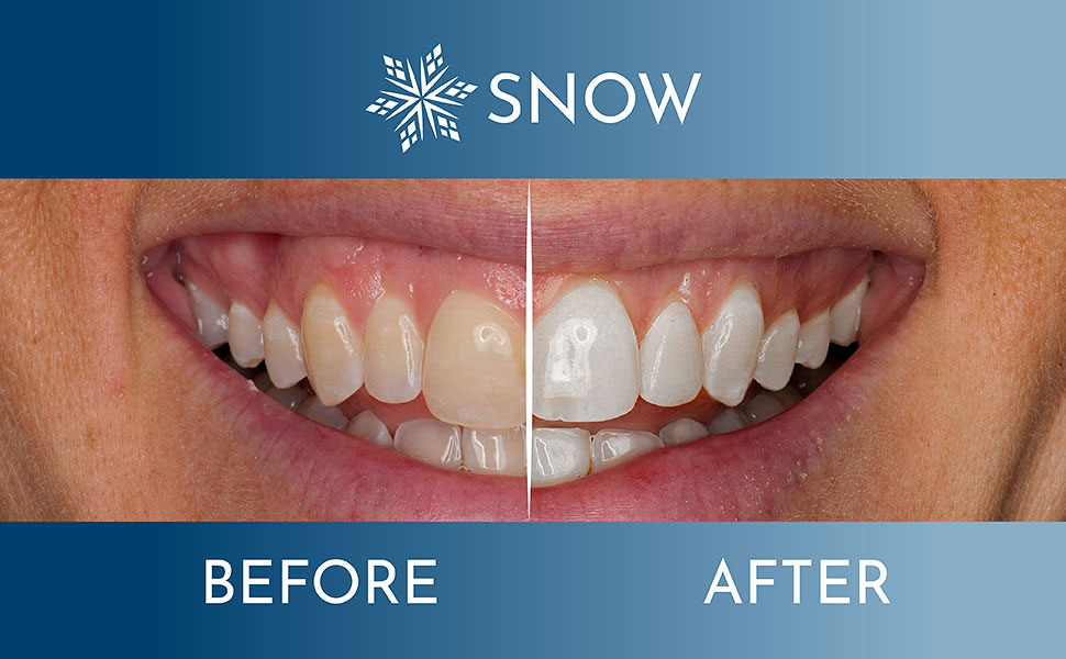 A desire to change with Snow teeth whitening