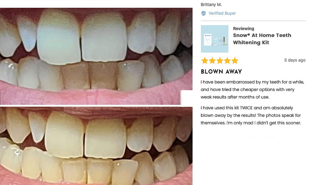 Snow teeth whitening kit before and after results
