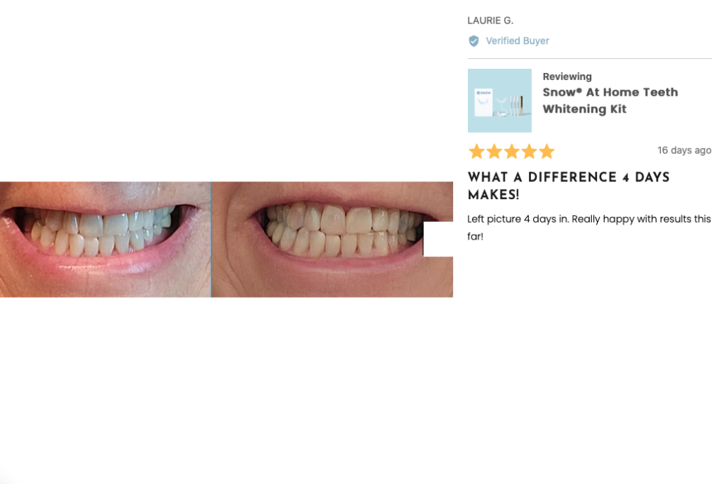 How long do I have to use the teeth whitening kit to see results?