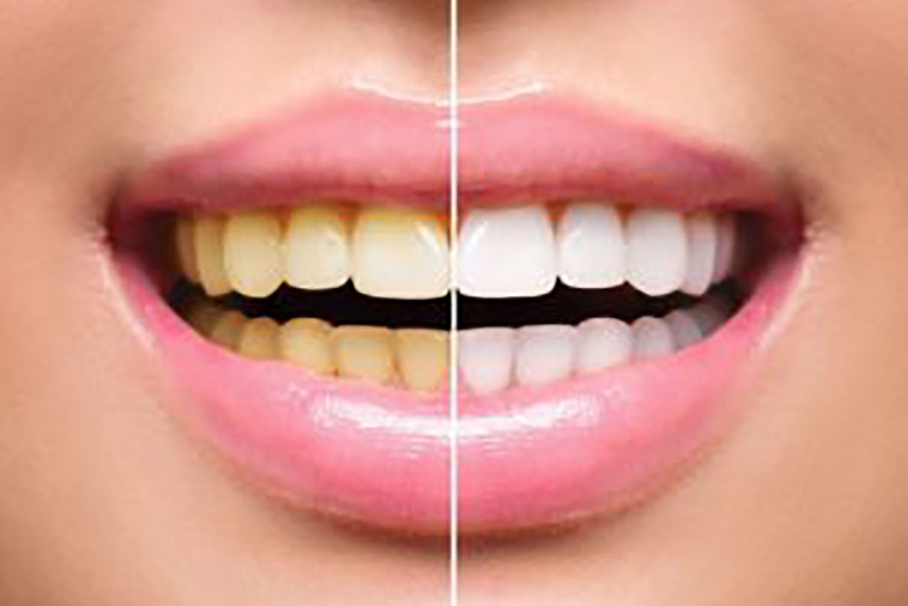 End your teeth whitening nightmares and Remove Nicotine stains fast.