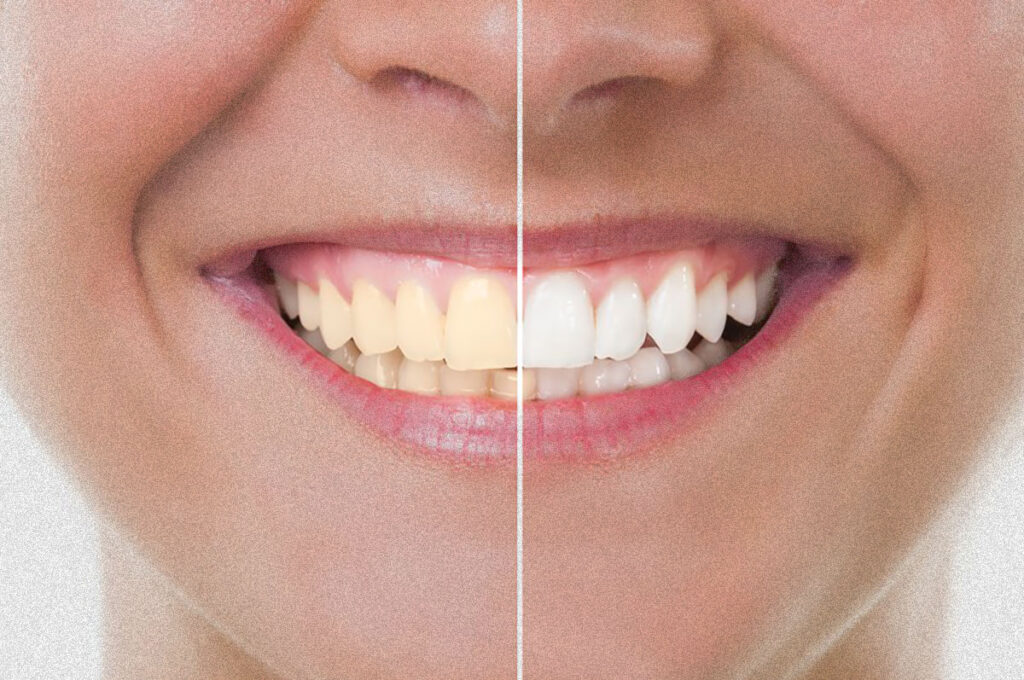Here are a few of the proven Teeth whitening kit benefits