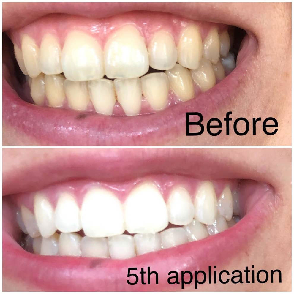 Do this to get teeth whitening results fast.