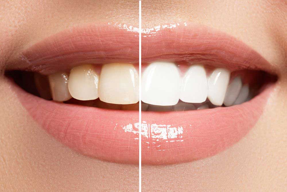 Is drinking coffee good for your Fantastic teeth whitening?